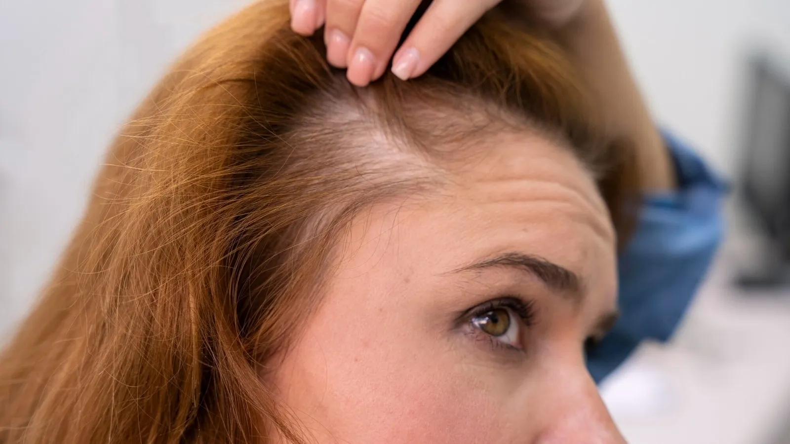 hair loss, alopecia, hair fall